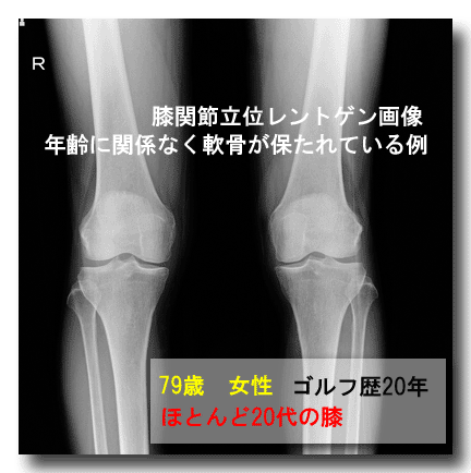 79歳なのに、20歳代の膝関節