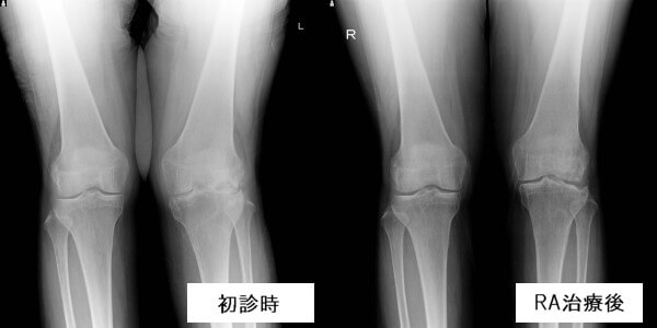 膝の腫れ 水がたまる原因とリウマチ 東京リウマチクリニック