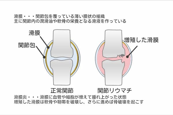 リウマチの関節超音波 エコー 検査とは リウマチ質問集q A 東京リウマチクリニック